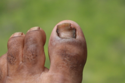 Toenail Fungus Treatments