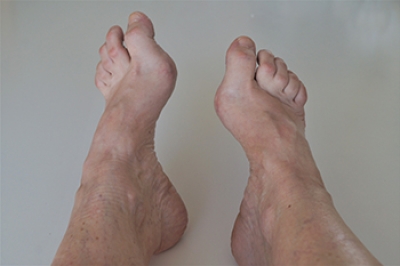 Foot Problems From High Arches